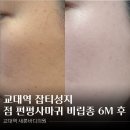 성지빌딩 | 교대역 피부과 점 편평사마귀 비립종 제거 6개월 후기 : 잡티제거성지 될만한..! (내돈내산)