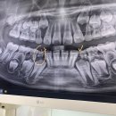 나래치과의원 | 편도아데노이드 수술 전, 이 뽑으러 어린이치과로 발치 @서판교 바른소아치과