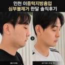 인천강남영상미디어고등학교 | 인천 송도성형외과 이중턱지방흡입 실리프팅 심부볼제거 마리오네트 지방이식 한달 솔직후기