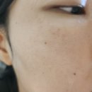 보셀르의원 | [공지] [내돈내산] 양평 보셀르의원 실펌(색소) 후기