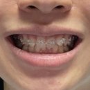 참사랑치과의원 - 화성시 동화길 81-10 | [동탄 교정치과] 연세참예쁜치과교정과치과의원 내돈내산 교정 시작 후기 (상담부터 윗니 부착까지)