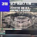 제일치과기공소 | [경험]금간 어금니, 생애첫 크라운 치료 후기...