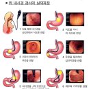 위암의 예방과 치료법 이미지