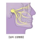 삼차 신경병증[Trigeminal neuralgia]뇌신경정신질환 이미지