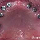 이주형치과의원 | 강남치과 틀니 빼고 전악 임플란트 식립 수술 과정