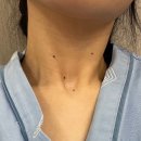 송도유외과의원 | 인천 송도유외과 피지낭종 제거 후기 (2탄) : 흉터, 실비청구 결과