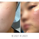 로네뜨 | [피부일기②] 접촉성 피부염에 추천하는 클렌징템 정리(내돈내산)