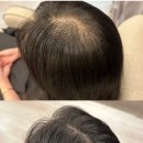 빈센트약국 | 탈모병원 방문후기 남자 정수리 탈모 치료 주사 효과 부작용 가격