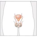 전립선염, 전립선비대증. 이미지