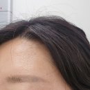 우원컨설팅 | 분당 눈썹 잔흔제거 잘하는곳 브로우원 붉은자국 제거하기