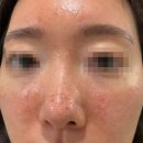 연재한의원 | 수원 주사피부염 홍조 치료 모공리액터 4회차 후기 (+모공 레이저)