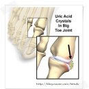 ﻿﻿통풍 (요산 관절염 )﻿ 이미지