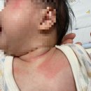국립중앙의료원 | [아토피/습진] 4개월 아기 국립중앙의료원 아토피 진료 후기 (습진 관리 방법/연고)