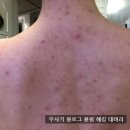 알라딘 | 등드름피부과 알라딘필링 후기