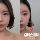 (주)이오젠 | 윤곽관리, 데콜테 관리, 흉터치료 한번에 해결 받은 강에스테틱 “인오젠 고주파 프락셔널 관리”