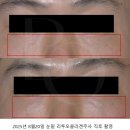이지미의원 | 하남 위례 피부과 2월 핑크글로우 이벤트 - 힐로웨이브 리투오 레프톤 수면리쥬란 쥬베룩볼륨 텐쎄라 텐...