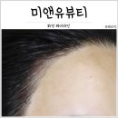 미앤유 헤어라인 | 화정 헤어라인, 자연스러워~ 미앤유뷰티