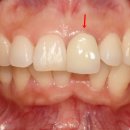 웃자치과교정과치과의원 | 50대 과개교합 부분교정 후기 오래된 크라운 교체로 정돈한 앞니 심미치료
