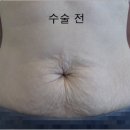 바디성형 처지고 변형된 몸매교정/처진살수술 이미지