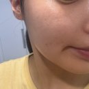 노블레스피부과의원 | 서면 노블레스피부과(주근깨&amp;기미 레이저치료) 후기