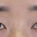 꼼꼼성형외과의원 네이버블로그