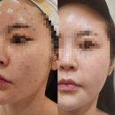 속초 피부관리 피부톤 정화에 도움을 주는 텐소노DSS