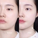 (주)하나로메디컬 | 피부리프팅 기기 ! 홈쎄라 뷰티디바이스 1개월차 효과 후기