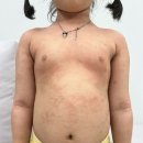 온재한의원 | 6살 피부 습진 아토피 한약 치료 2주 후기 _ 천안 아산 **한의원