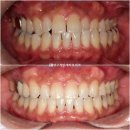 이경우치과의원 | 30대 비수술 비대칭 주걱턱 MSE 악궁확장 장치 반대교합 클리피씨 교정 치료기간 2년 후기 사진 기록