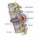 메디온랩 | 허리디스크 운동 제대로 하면 이렇게 좋아집니다 (실제 효과 정리)