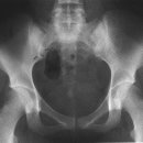 천장관절증후군(sacroiliac joint syndrome) 이미지