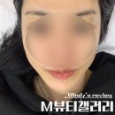 세계생기뷰티갤러리 | 춘천 M뷰티갤러리 알테온 리프팅 내돈내산 1회 vs 2회 효과 비교 후기