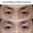디비솔루션 | 중년눈성형비용 비교 후기 찾아보기 전에
