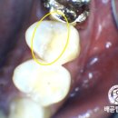 배곧탑치과의원 | 식사중에 '악~'하고 아팠을땐 배곧탑치과로 가즈아~(feat.금간치아)