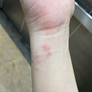 고양 습진 한의원에서 한방치료 받은 후기