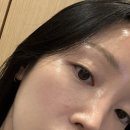 눈부심 | 서면 피부과에서 눈부심주사 맞은 후기