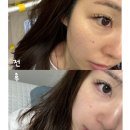 5366 | 아윤에스테틱 독일물광보노필 관리 후기, 얼굴에 물광이 촤르르✨