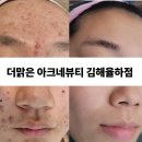 더맑은아크네뷰티
