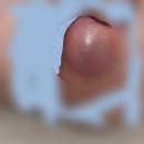 자주고름 | 엉덩이에 뾰루지와 반복되는 엉덩이 종기 고름 관리후기