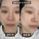 미드림인테리어 | 검단 불로동 피부관리 미드림 좁쌀 여드름 요철 박멸 후기