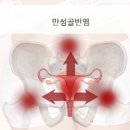 골반염 증상 원인 골반염 질환 치료 예방 골반 통증 이미지