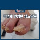레푸스앤네일맘