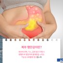 복부팽만감 원인 가스 유발 질환 4가지 및 증상 이미지