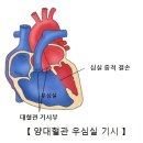 양대혈관 우심실 기시증[Double outlet right ventricle소아청소년질환, 순환기질환] 이미지