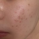 밝은마음한의원 | 부산 서면 새살침 한의원 패인흉터 치료 2회 후기