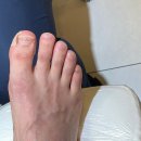 레푸스 수원광교점 | 수원 내성발톱 교정 레푸스 수원광교점에서 교정 받은 후기에요