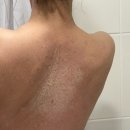 알라딘한의원 | 성남 분당 한의원 등 여드름 흉터없앤 내돈내산 후기