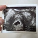 임신 5주3일차 난황확인! 연세아이소망여성의원 졸업 후기 (인공수정1차 성공)