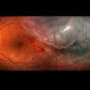 (주)빛과번쩍 | 눈앞 번쩍임, 빛이 퍼져 보인다면?