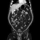 비에비스나무병원 | "담낭관이 두 개라고?" 수술실에서 만난 식은땀 나는 순간, 'True Double Cystic Duct' 극복기